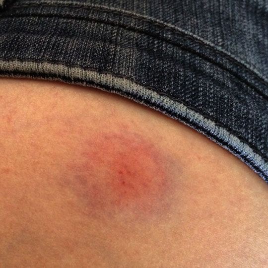 photo war-wound_zps393493bd.jpg